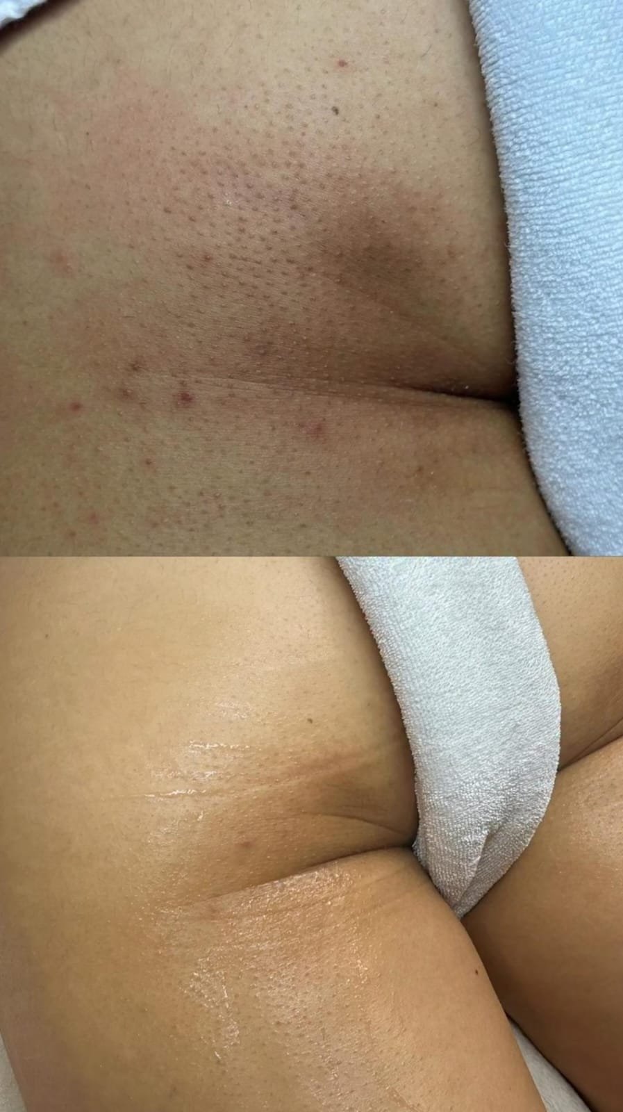 Before and after Full Body Exfoliation & Scrub treatment
